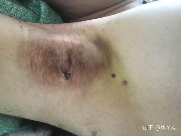 腋下异味治疗最新进展，科技之光引领健康之路