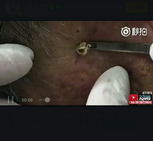 最新挤黑头视频大全与探索自然美景的治愈之旅
